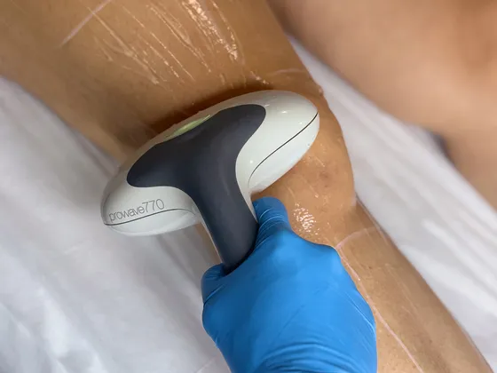 A laser hair removal treatment